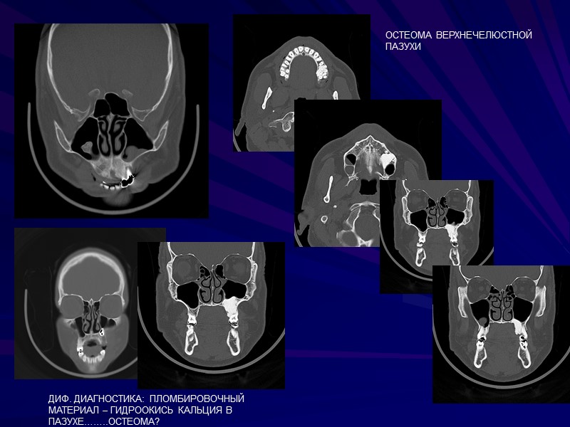 ОСТЕОМА ВЕРХНЕЧЕЛЮСТНОЙ ПАЗУХИ   ДИФ. ДИАГНОСТИКА: ПЛОМБИРОВОЧНЫЙ МАТЕРИАЛ – ГИДРООКИСЬ КАЛЬЦИЯ В ПАЗУХЕ……..ОСТЕОМА?